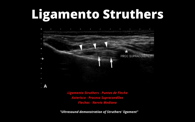 Ligamento Struthers.png